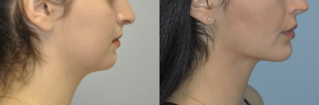 Before and After Deep Neck Contouring in Palo Alto, CA